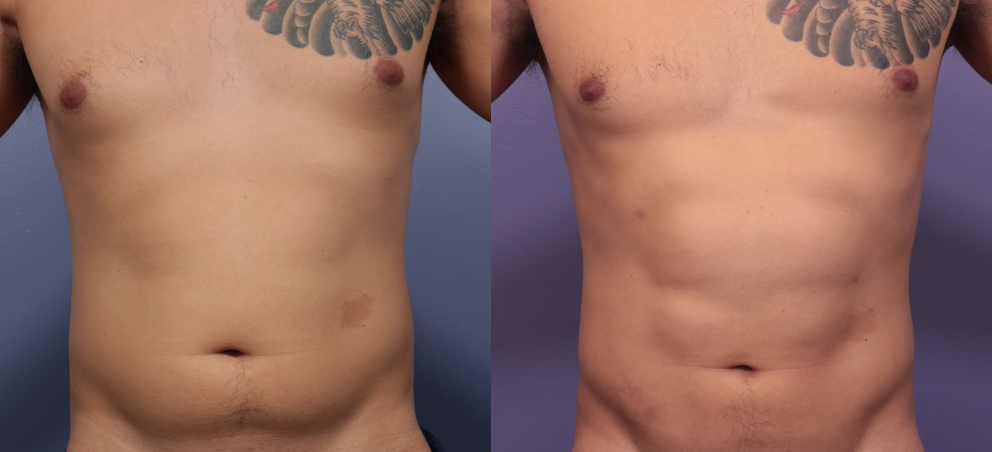 Men's abdomen sculpting result