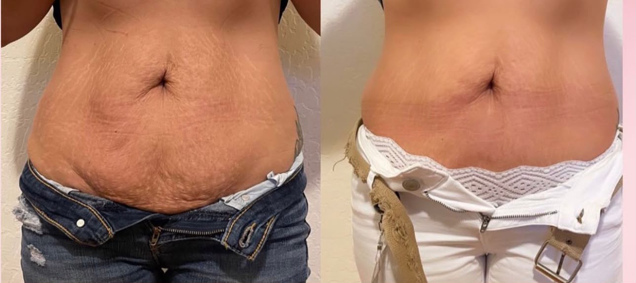 Lower abdomen skin tightening result