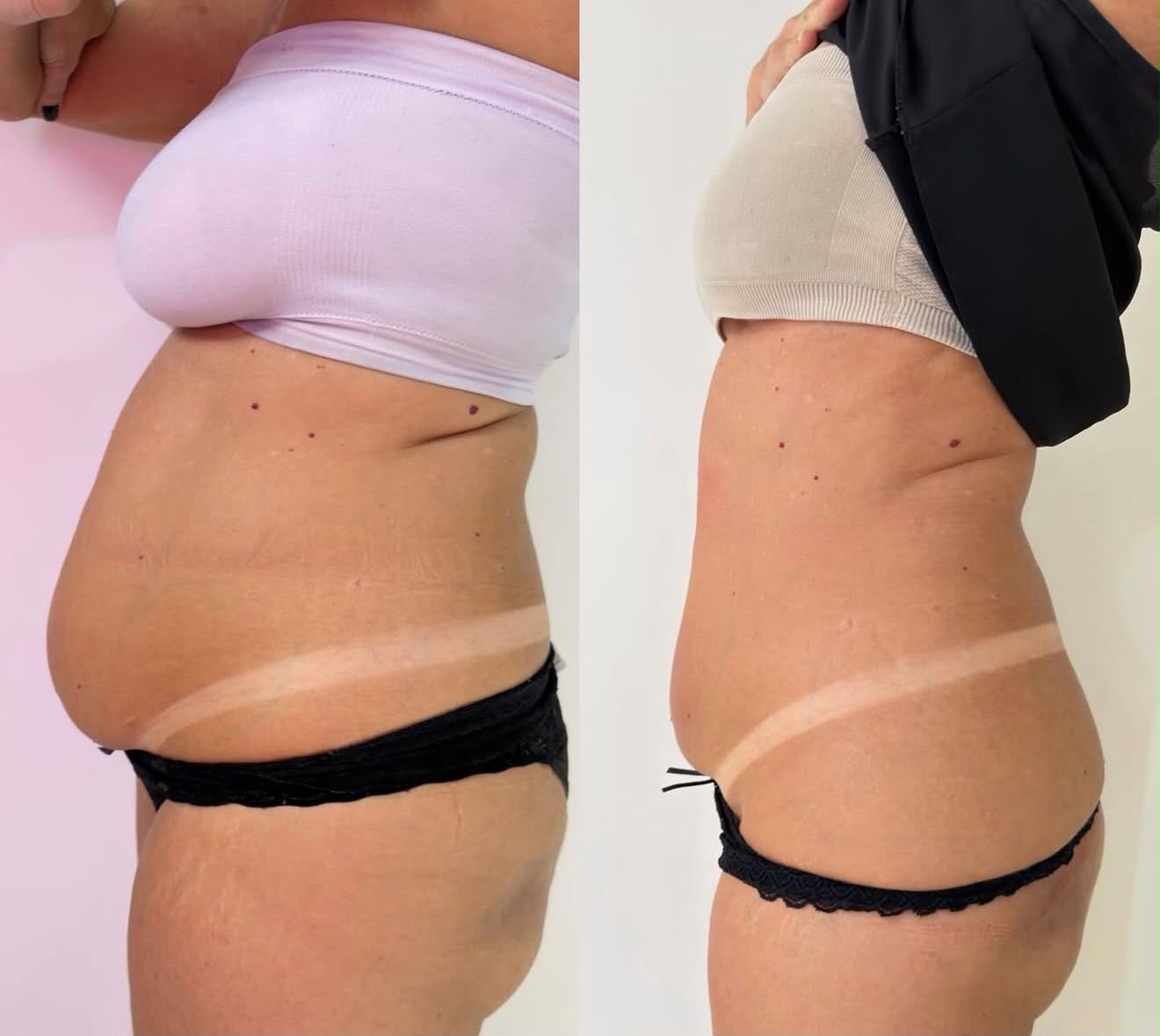Side profile tummy sculpting result