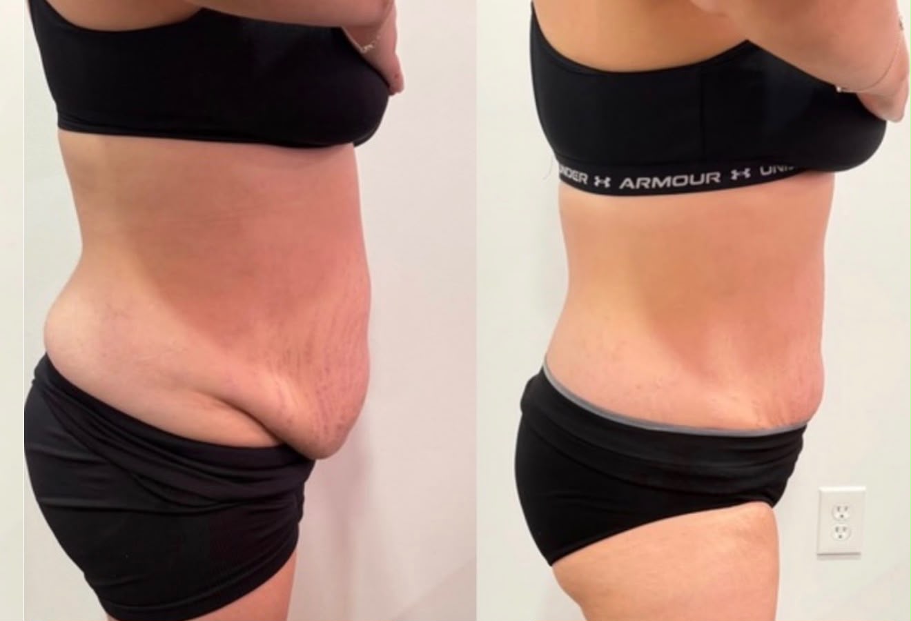 Waistline & back sculpting result