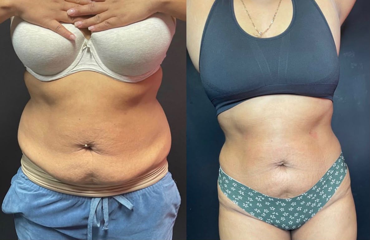 Front tummy contouring transformation